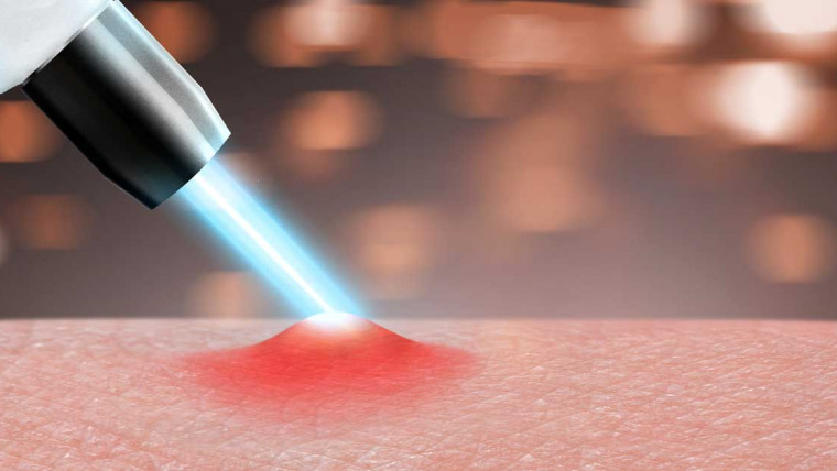 laser za akne