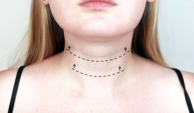 horizontalne bore na vratu