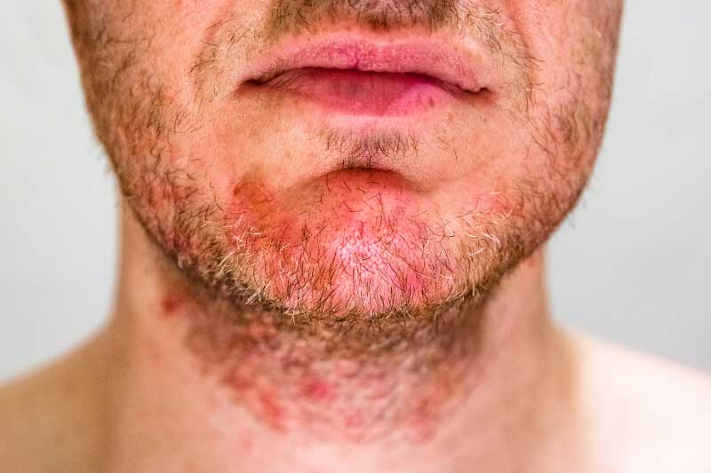 seboreični dermatitis na licu