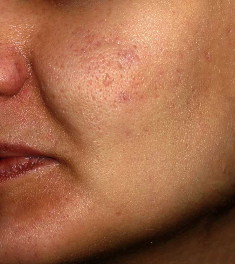keloidni ožiljci od akni na licu